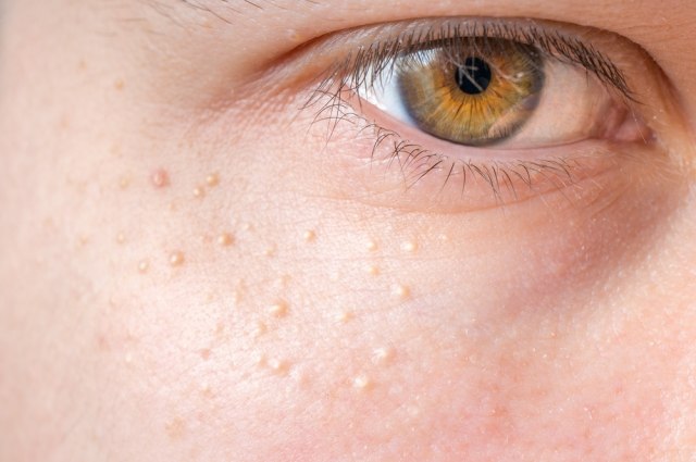 Tri simptoma da vam se nagomilao loš holesterol se vide na predelu oko očiju